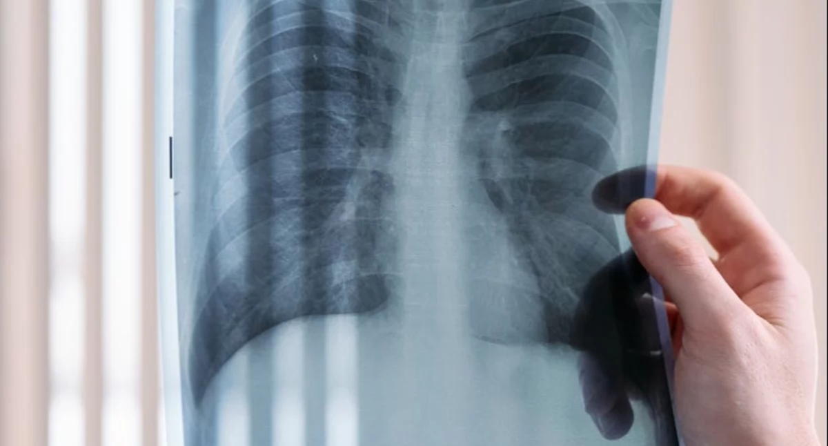 Materiał zewnętrzny, POChP Najważniejsze informacje przewlekłej obturacyjnej chorobie płuc - zdjęcie, fotografia